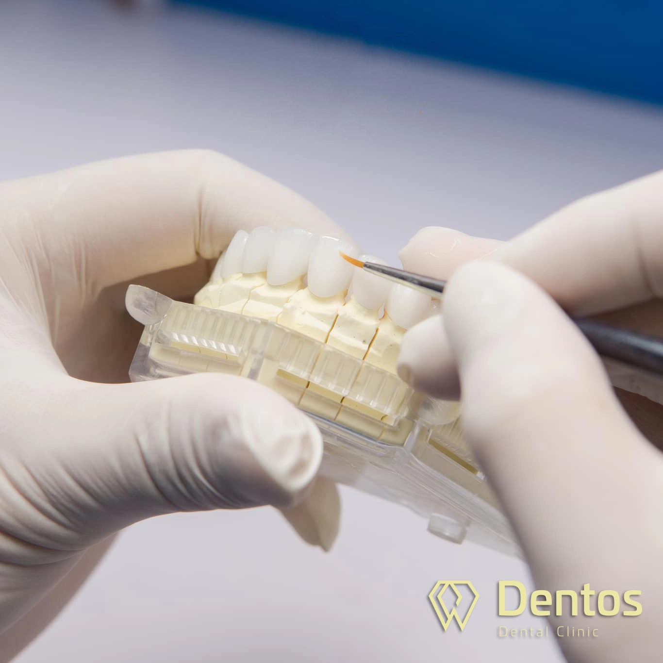 Mão răng là gì? - Là một loại mão nhân tạo chế tác từ các vật liệu nha khoa như sứ, kim loại, titan